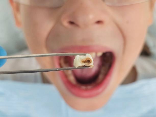Best Knocked-Out Tooth Emergency  in Cheraw, SC